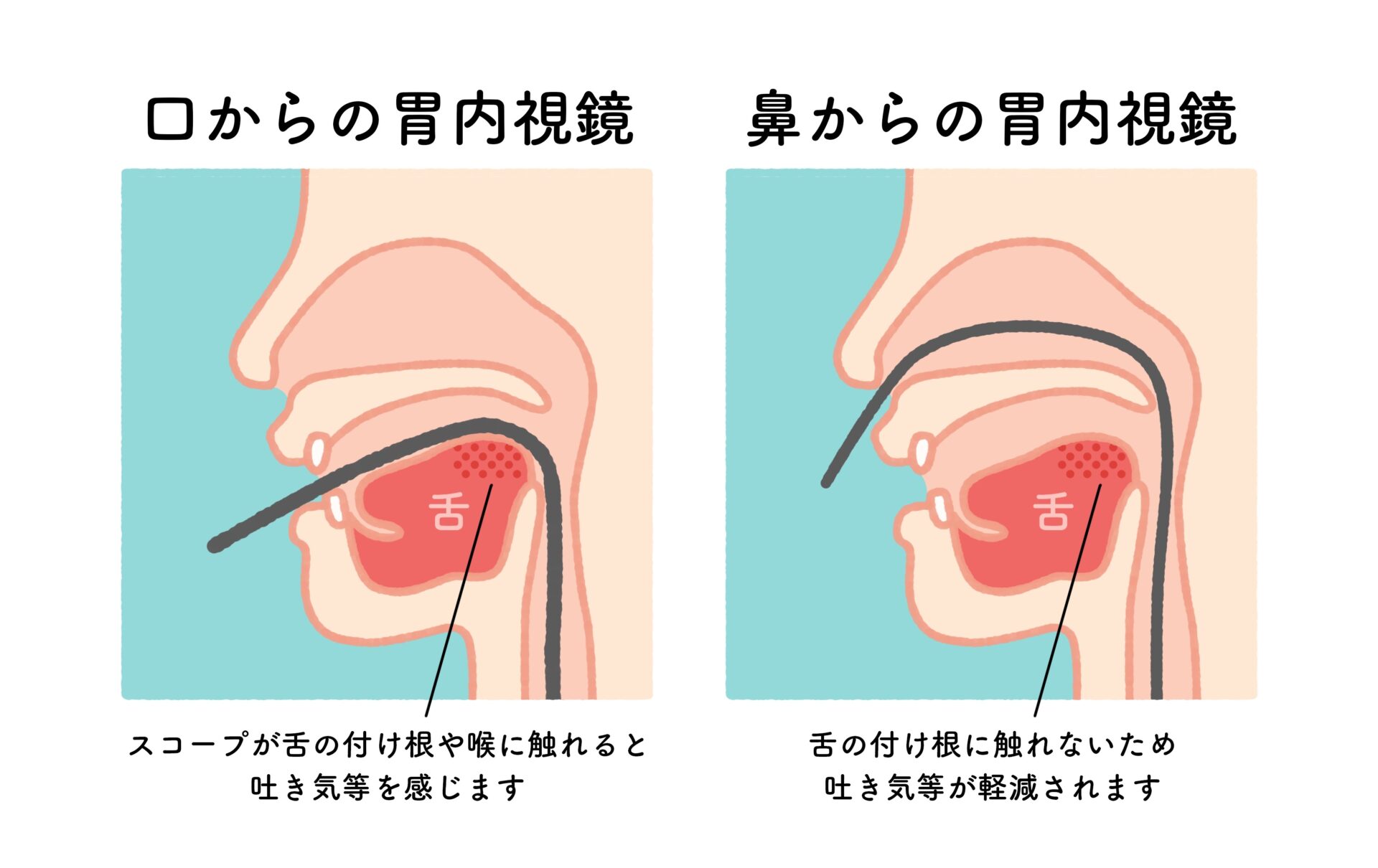 【イラスト】口からの胃内視鏡・鼻からの胃内視鏡イメージ