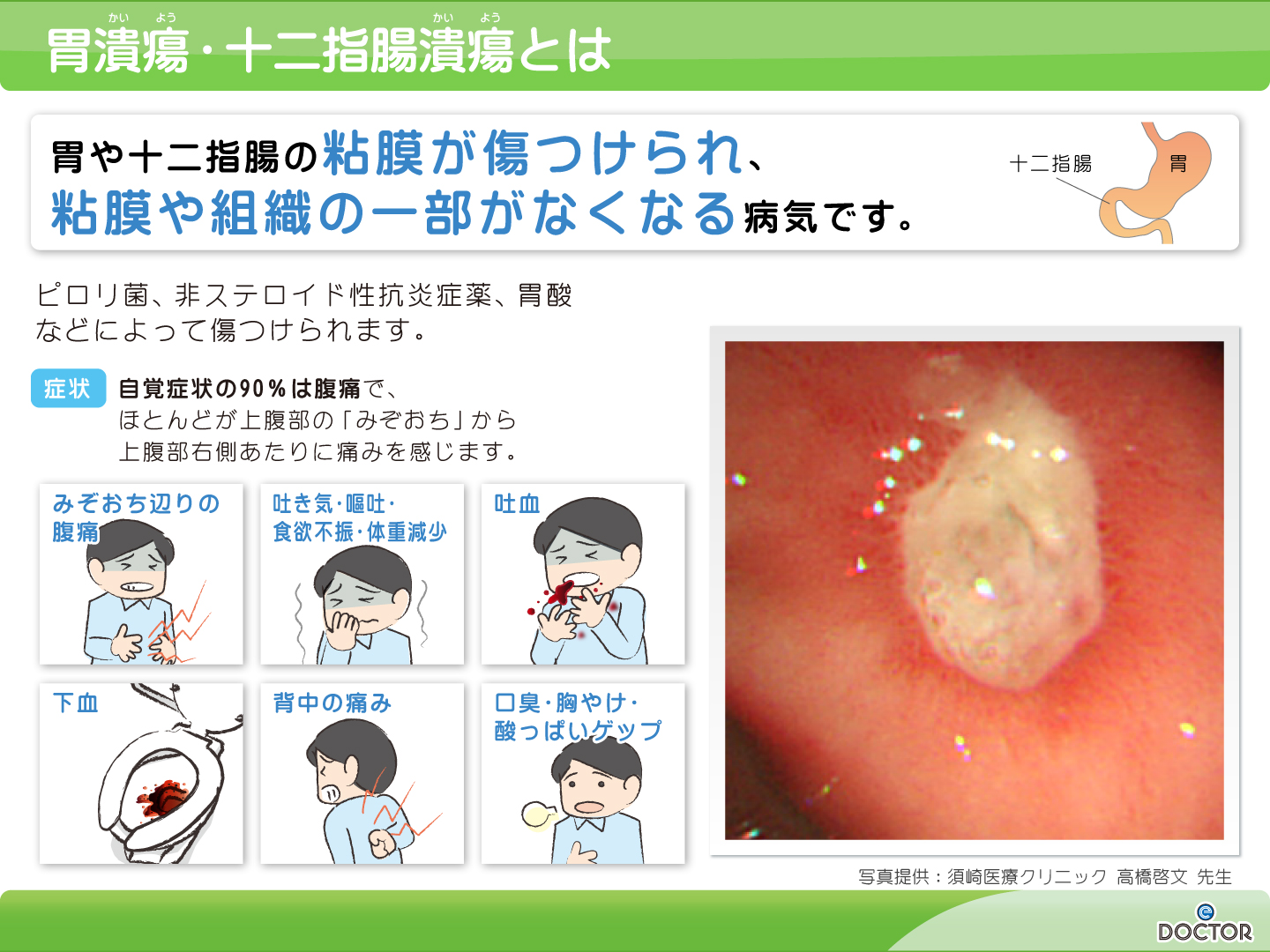 胃潰瘍・十二指腸潰瘍 神奈川県横浜市の内科、消化器内科、内視鏡内科 横浜駅前ひさゆき消化器内科・内視鏡クリニック