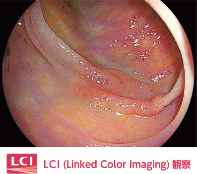 【画像】LCI/大腸カメラ