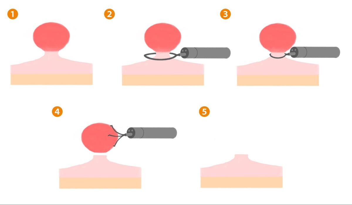 大腸ポリープの発見から切除までの順序を表したイラストのイメージ図