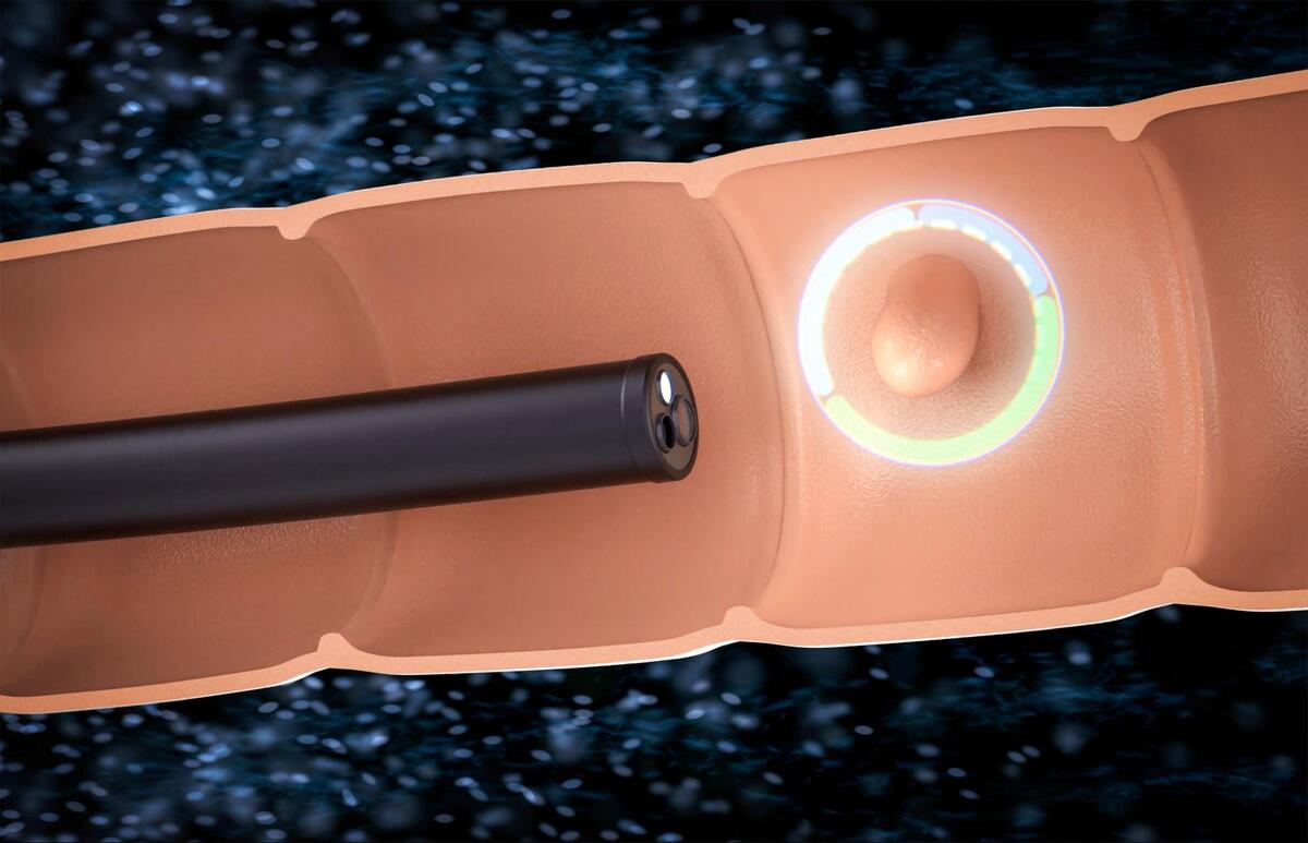 大腸カメラ検査のイメージ図