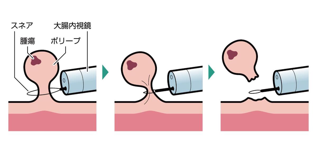 大腸ポリープを切除する手順をイラストで表したフロー図